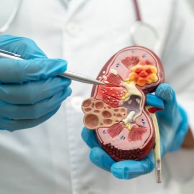 Face of Chronic Kidney Disease Face of Chronic Kidney Disease