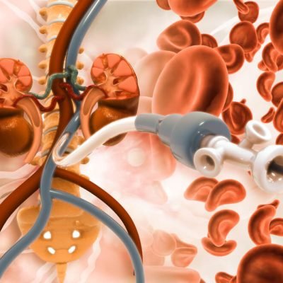 angioplasty