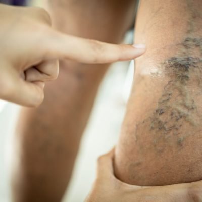 vericose veins